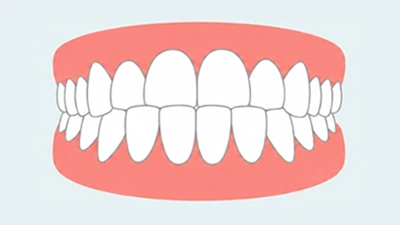 Underbite