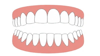 Open Bite